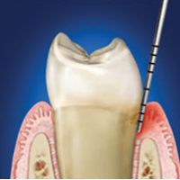 Ínygyulladás 1 Ínygyulladás 1