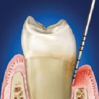 Ínygyulladás 2 Ínygyulladás 2