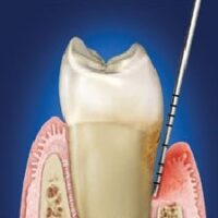 Ínygyulladás 3 Ínygyulladás 3