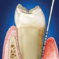 Ínygyulladás 4 Ínygyulladás 4